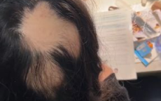 辅导作业压力山大，85后宝妈遭遇“鬼剃头”危机